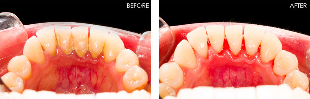 스케일링 후 주의사항