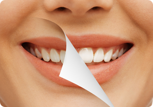 스케일링은 치아미백효과가 있다?