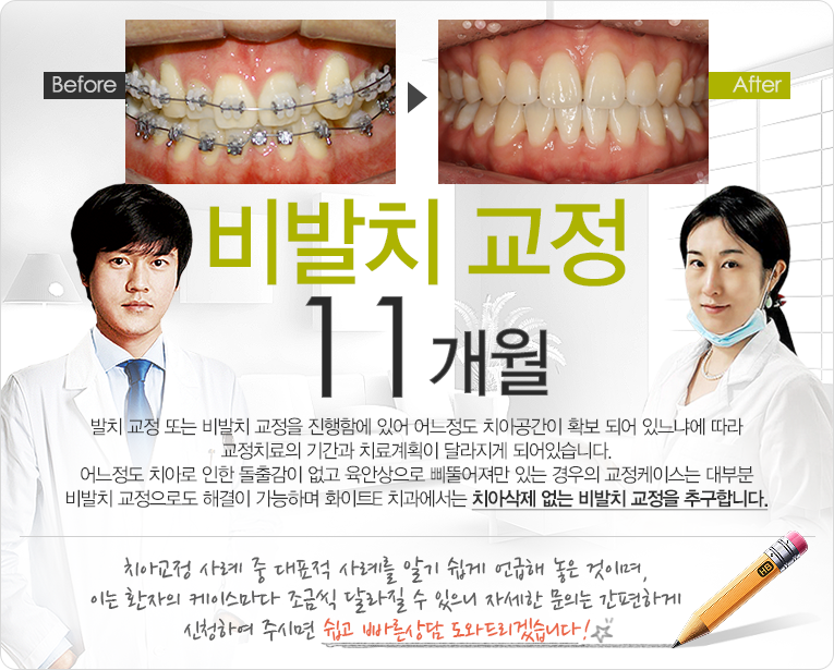 비발치 교정 6개월