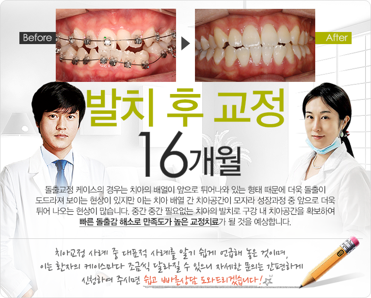 발치 후 교정 12개월