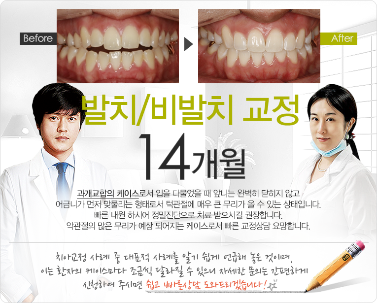 비발치 교정 11개월