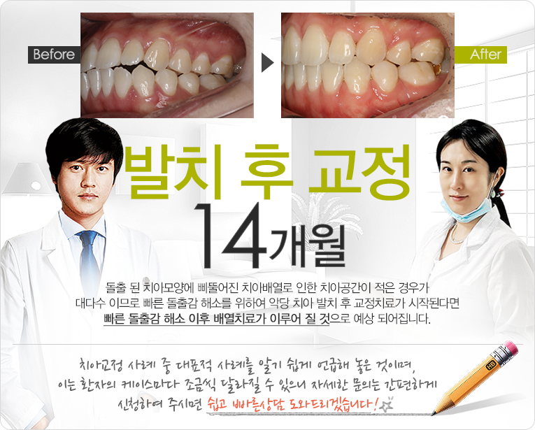 비발 후 교정 10개월