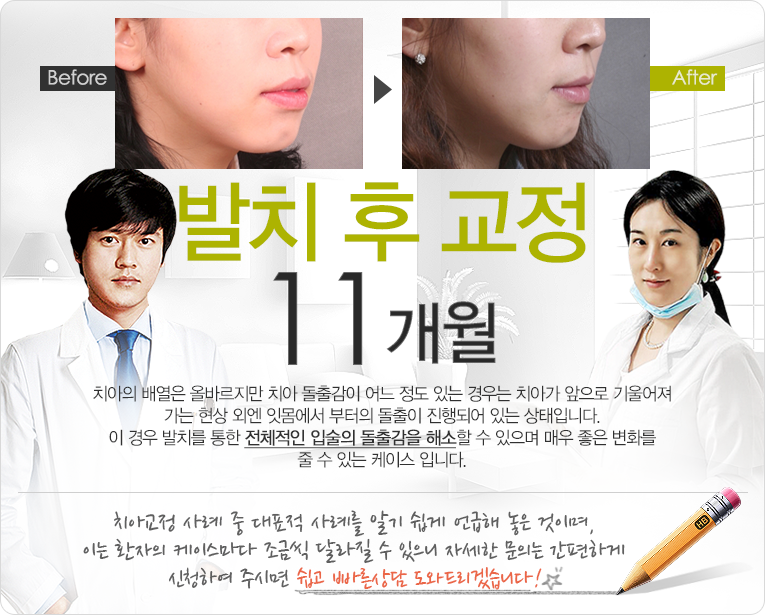 비발 후 교정 9개월