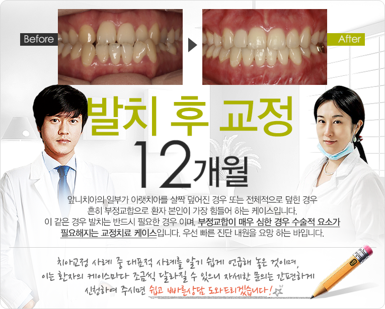 급속교정 10개월권장