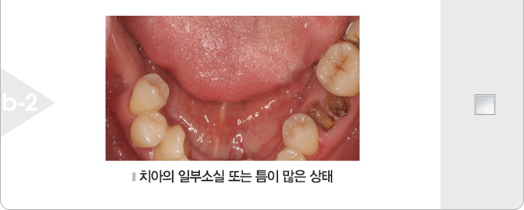 치아의 일부분이 틈이 있는 상태