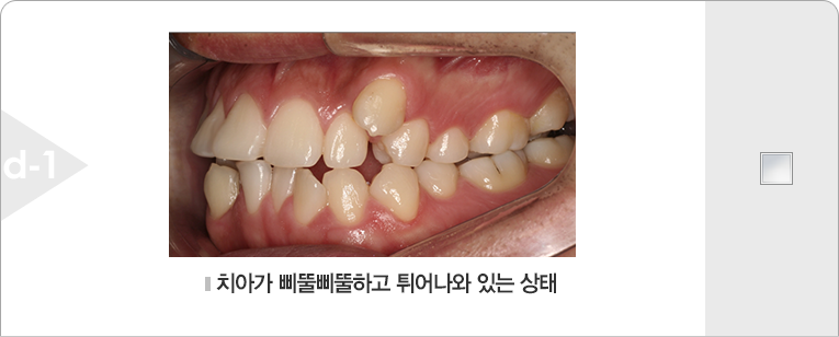 치아가 삐뚤삐뚤하고 튀어나와 있는 상태