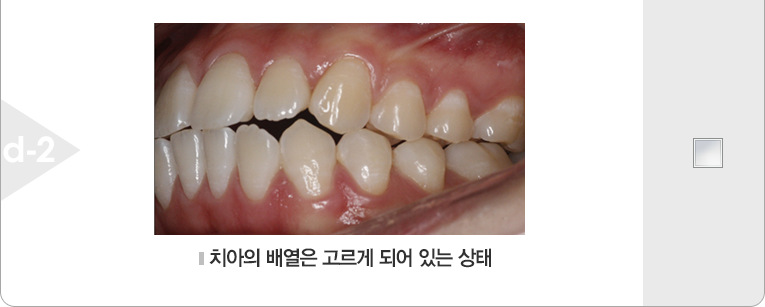 치아의 배열은 고르게 되어 있는 상태