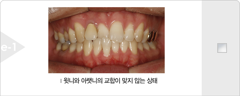 윗니와 아랫니의 교합이 맞지 않는 상태